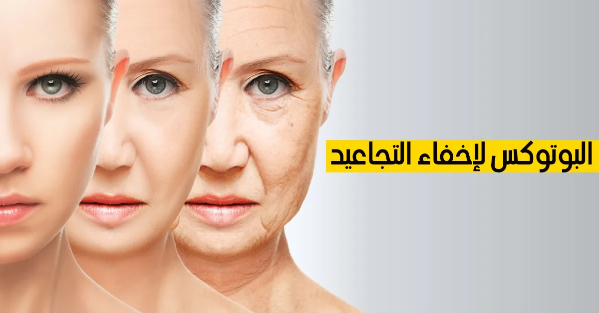البوتوكس لإخفاء التجاعيد